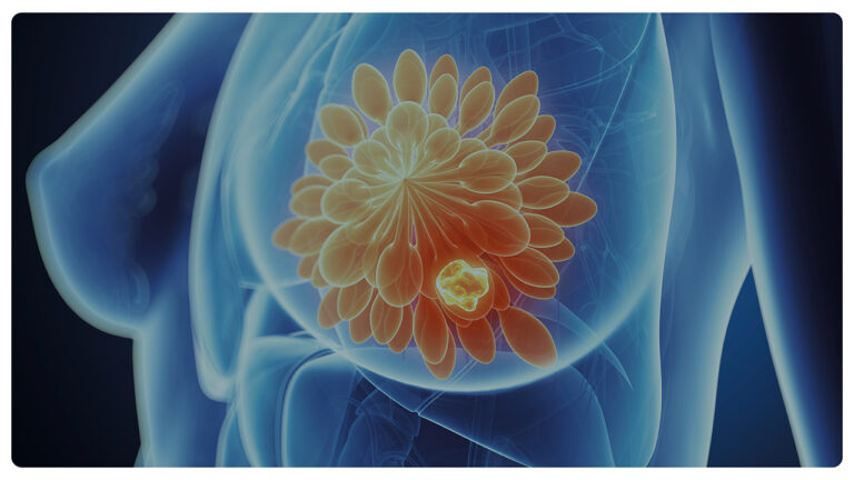 Regione Lazio: Carcinoma alla mammella Her2 Positivo, approvato accesso gratuito a farmaco costosissimo