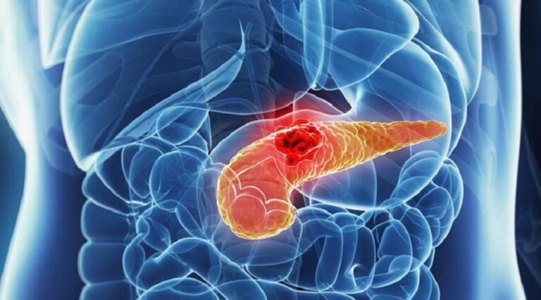 Tumore al pancreas, individuato da uno studio italiano un meccanismo chiave nella patogenesi