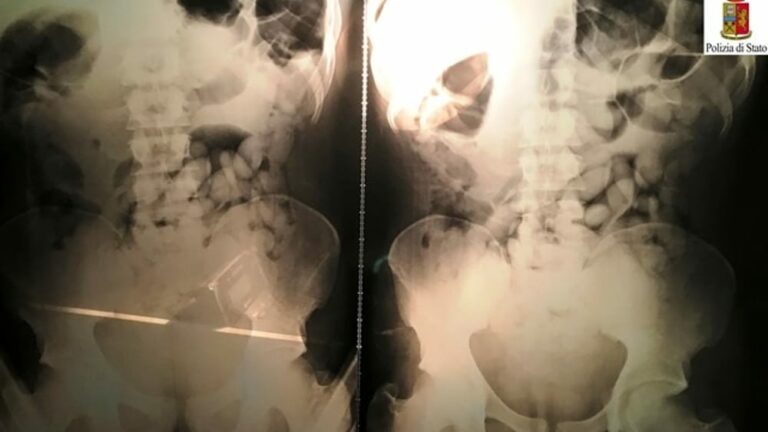 Aveva tre ovuli di cocaina nello stomaco – Arrestato in Provincia di Latina corriere del narcotraffico