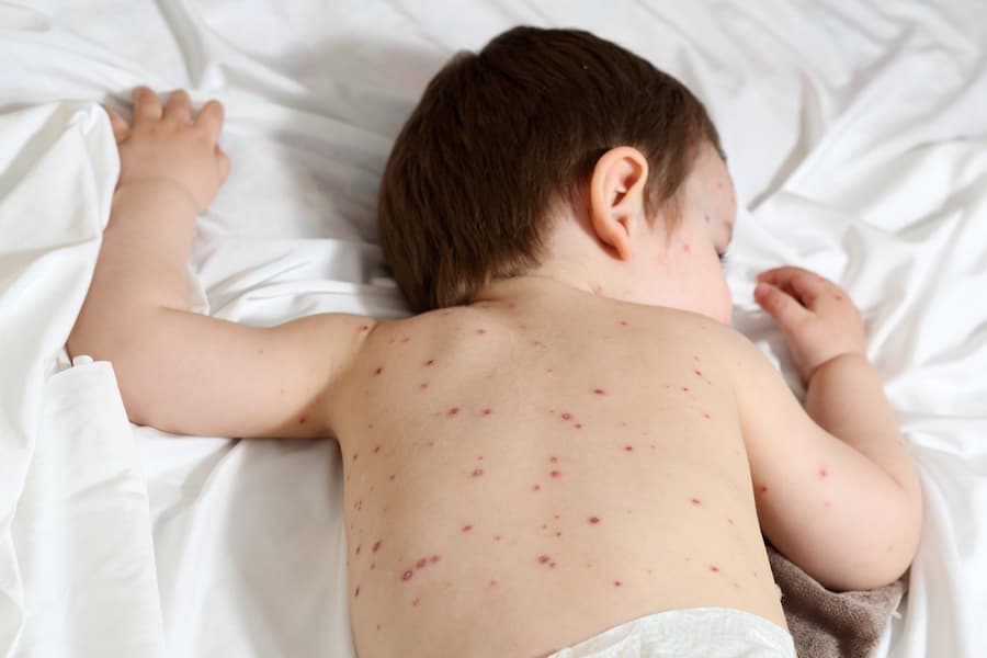 MORBILLO E ROSOLIA: DA APRILE 2020 NESSUN CASO