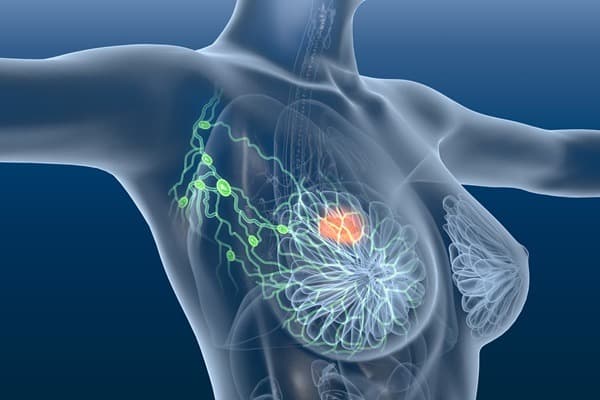 Tumore al seno metastatico: la muova terapia con Trastuzumab Deruxtecan