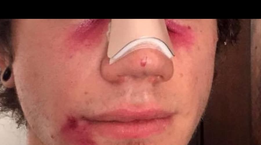 Aggredisce un coetaneo procurandogli una frattura al naso