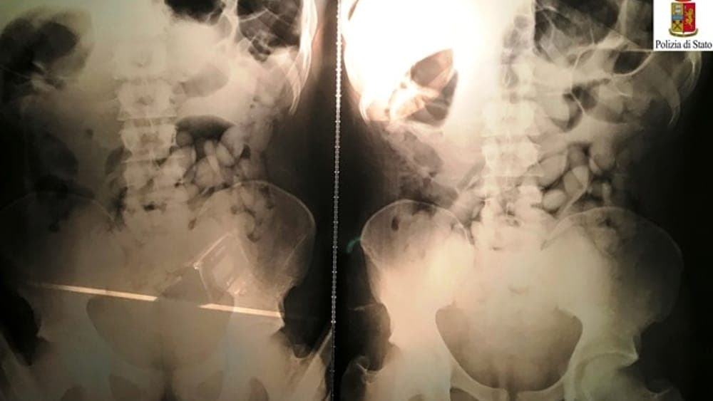 Aveva tre ovuli di cocaina nello stomaco - Arrestato in Provincia di Latina corriere del narcotraffico