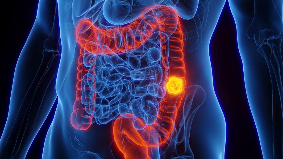 Tumore del colon-retto, via libera al mix terapeutico che cambia la prognosi: “Sopravvivenza raddoppiata”