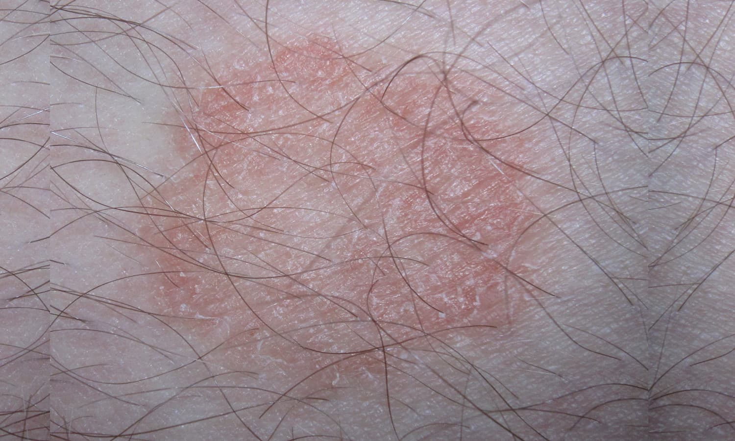Malattia della pioggia