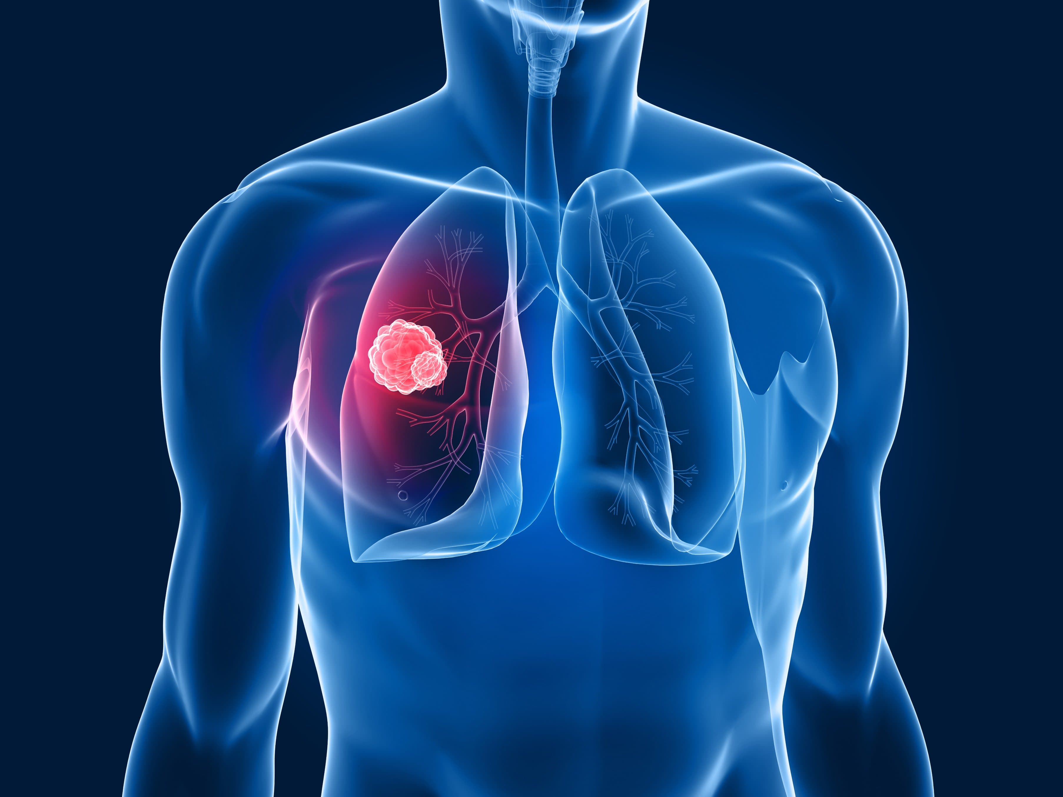 TUMORI: I DATI ONCOLOGICI IN PROVINCIA DI LATINA