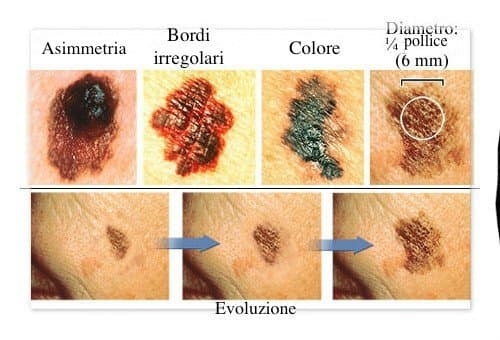 Melanoma: in Italia 7.000 casi l'anno per questo aggressivo tumore della pelle. Come riconoscerlo