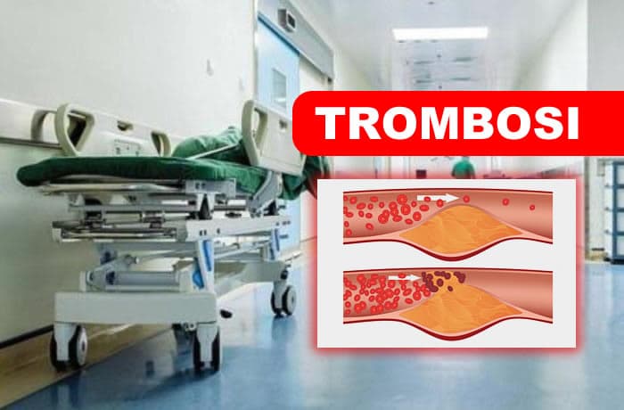 Cos'è la trombosi venosa profonda e quali sono i sintomi