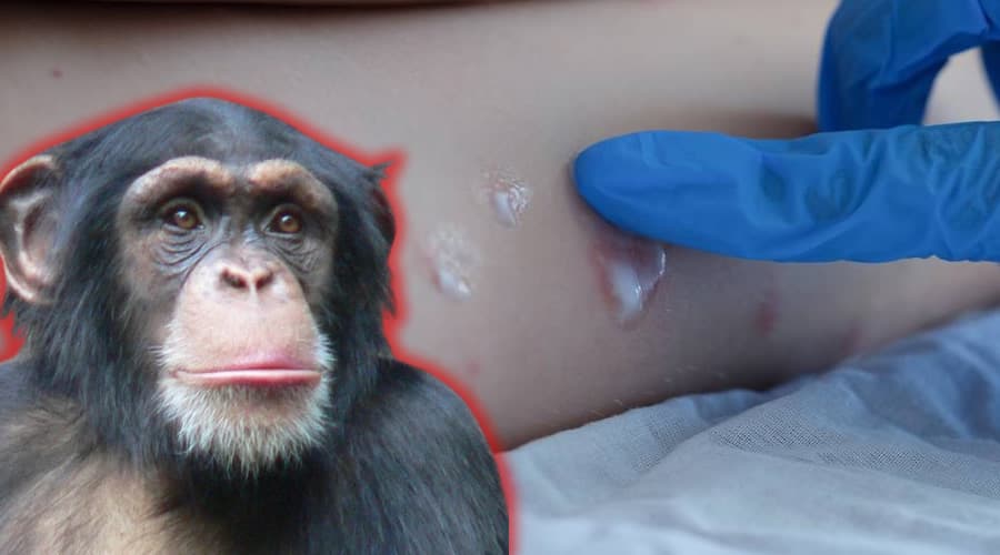 L'importanza della prevenzione nel MPXV. Ultimi dati. I casi in Italia. Dal 2022 si è registrato un caso a Latina.