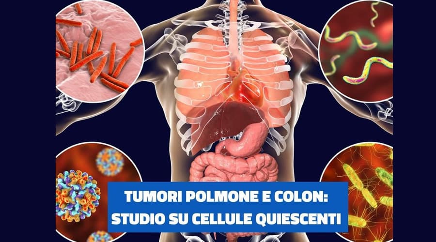 Tumore del polmone e del colon: scoperto un identikit comune delle cellule quiescenti e resistenti alle terapie
