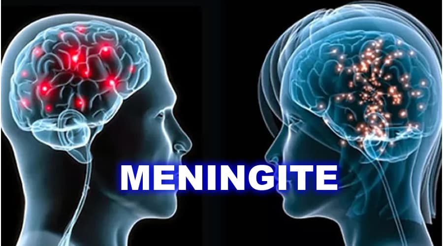 OMS: La meningite è una malattia infettiva mortale, può colpire chiunque a qualsiasi età ed essere fatale in poche ore