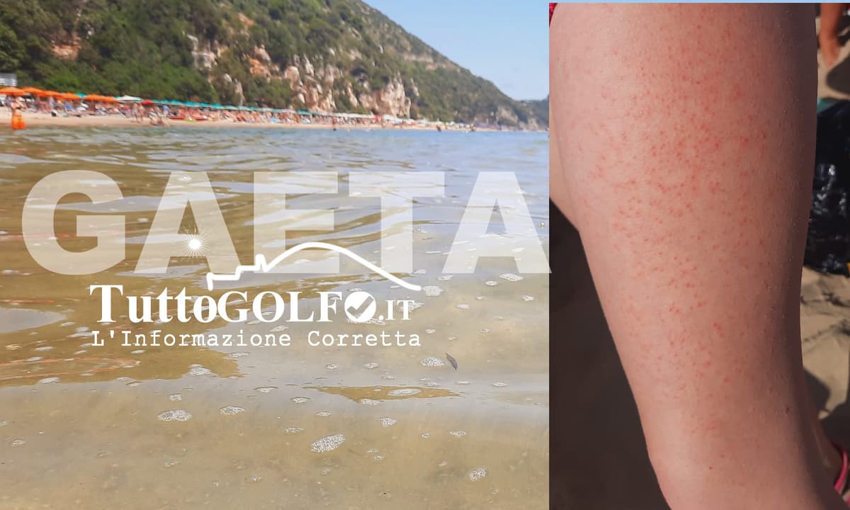 Schiuma in mare anche all’Arenauta: segnalazioni da Gaeta. Una mamma denuncia rush cutaneo dopo il bagno